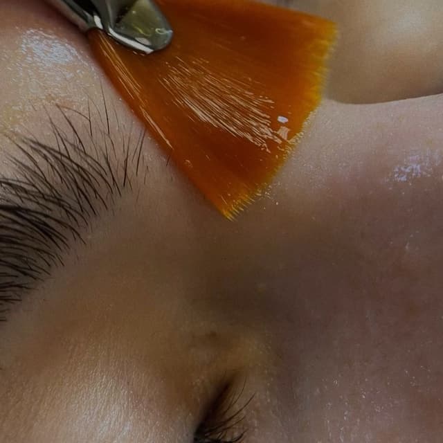 Glycolic Peel Series (6 Treatments) at Kallara Beauty in Oswego, IL